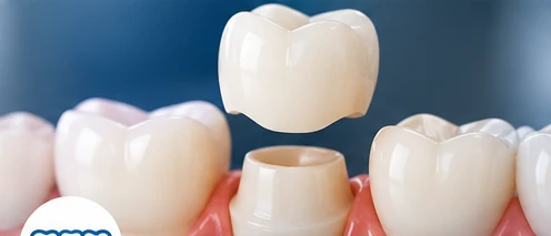 Crowns And Bridges dental treatment image