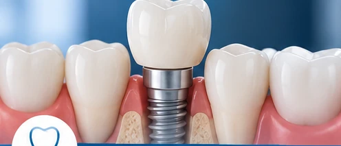Dental Implants dental treatment image