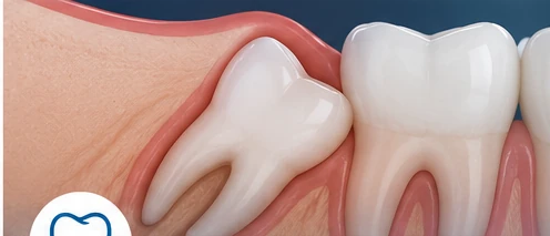 Wisdom Teeth Extraction dental treatment image